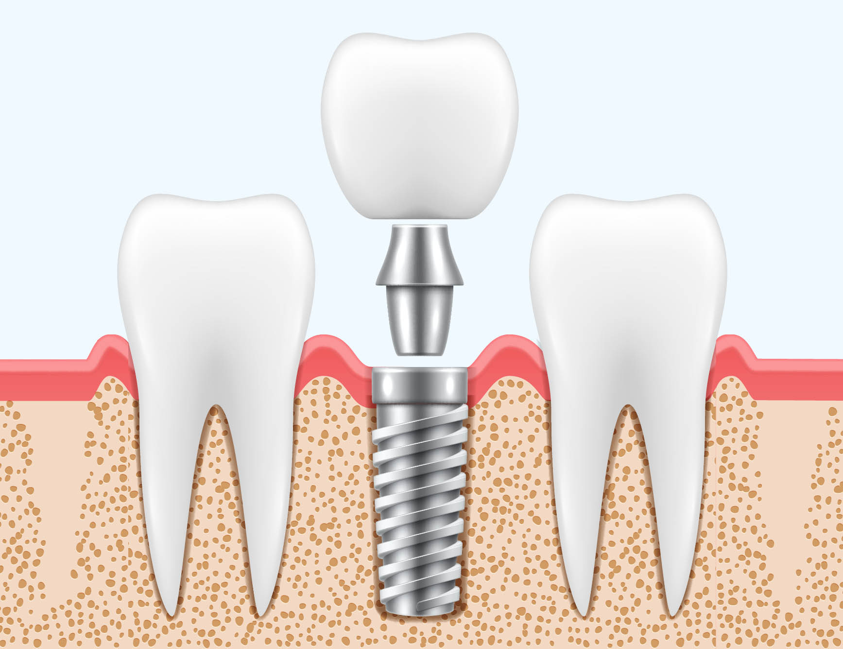 Restoration of Implants