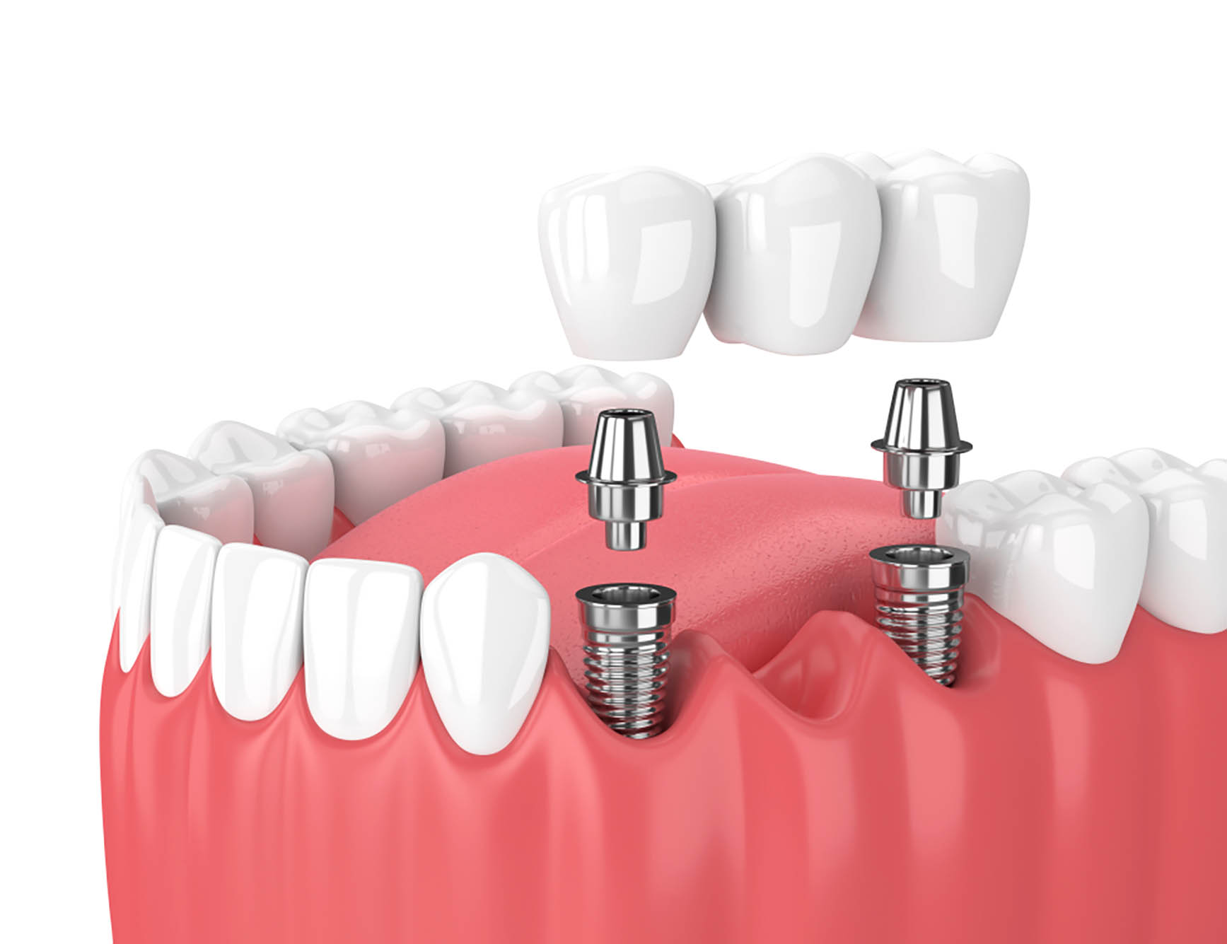 Cosmetic Crown & Bridge