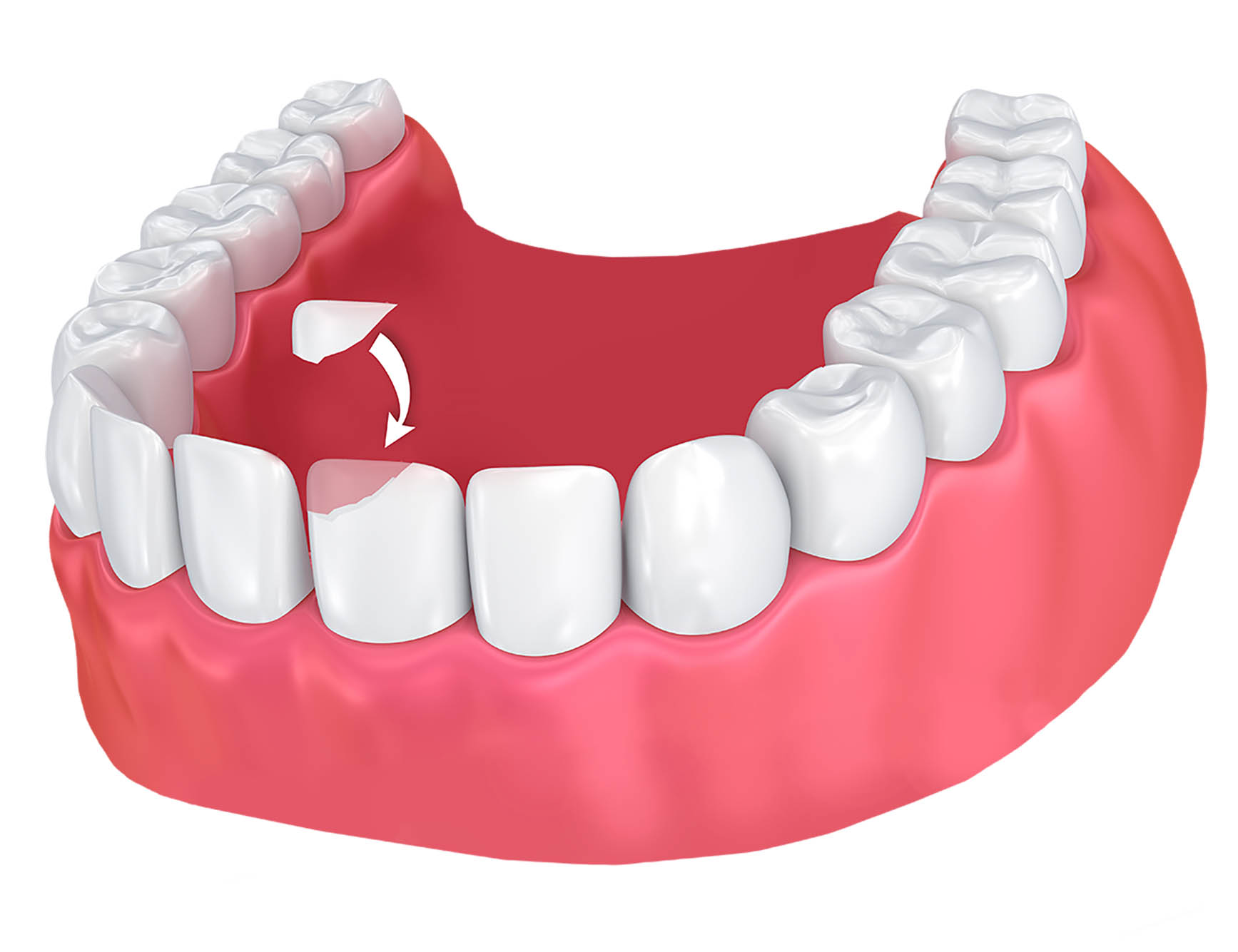 Composite Bonding