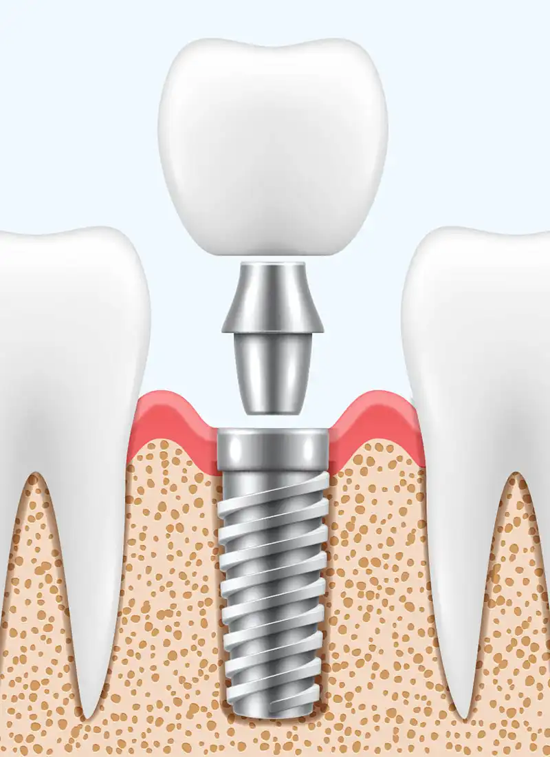 Restoration of Implants